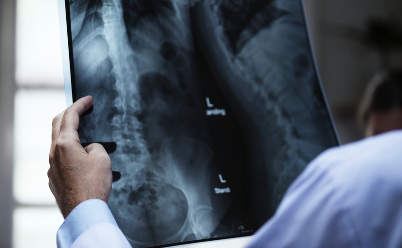 síntomas de la osteoporosis